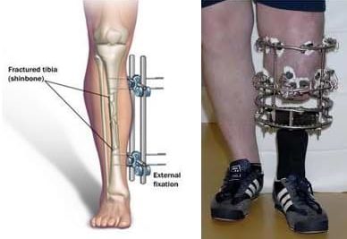 leg lengthening surgery