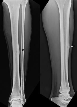 xray showing stress fracture