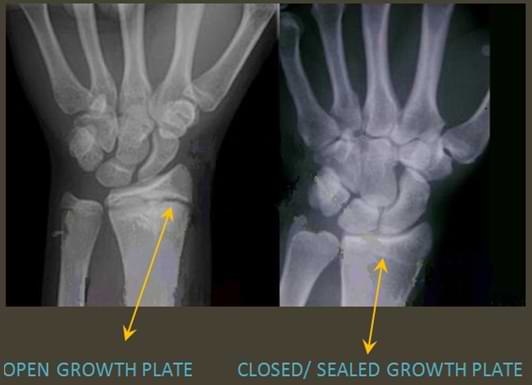 how-to-keep-growth-epiphyseal-plates-open-gtwsl