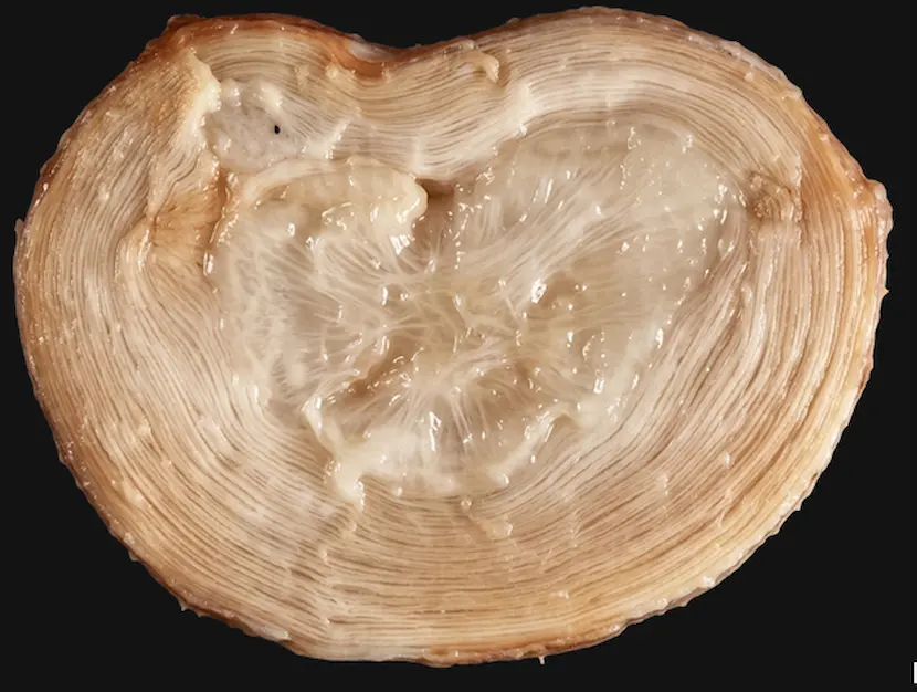 normal -spinal -disc